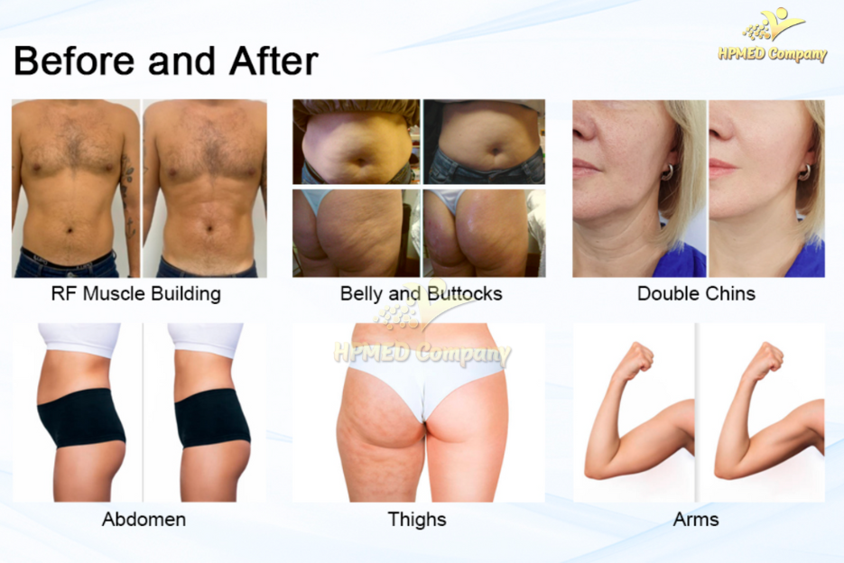 Các vùng cơ thể phù hợp với máy giảm béo Cavitation