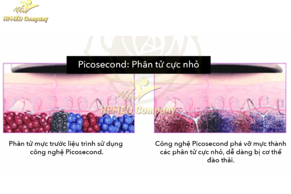 Laser Picosecond (PicoSure, PicoWay)