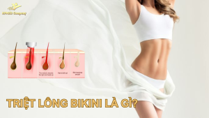 Triệt lông bikini là gì ? có các phương pháp nào ?