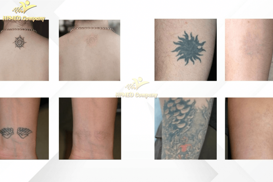 Máy Laser YAG Là Gì? Nguyên Lý Hoạt Động Của Công Nghệ Laser YAG 2025 5 Xóa xăm bằng Laser YAG