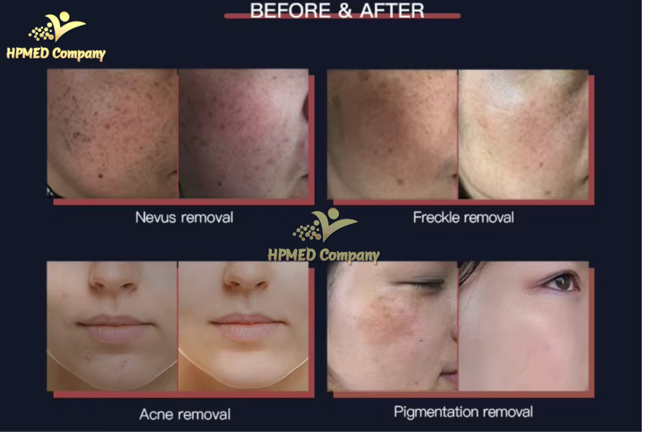 Máy Laser YAG Là Gì? Nguyên Lý Hoạt Động Của Công Nghệ Laser YAG 2025 4 Ai Nên Và Không Nên Sử Dụng Máy Laser YAG?