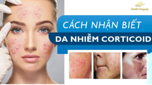 Hình ảnh soi da bị nhiễm corticoid