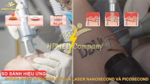 So sánh hiệu ứng Quang nhiệt và Quang cơ của Laser Nanosecond và Picosecond