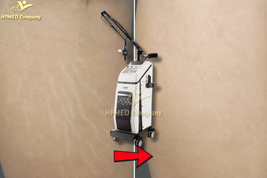 Laser CO2 Fractional Trị Rạn Da