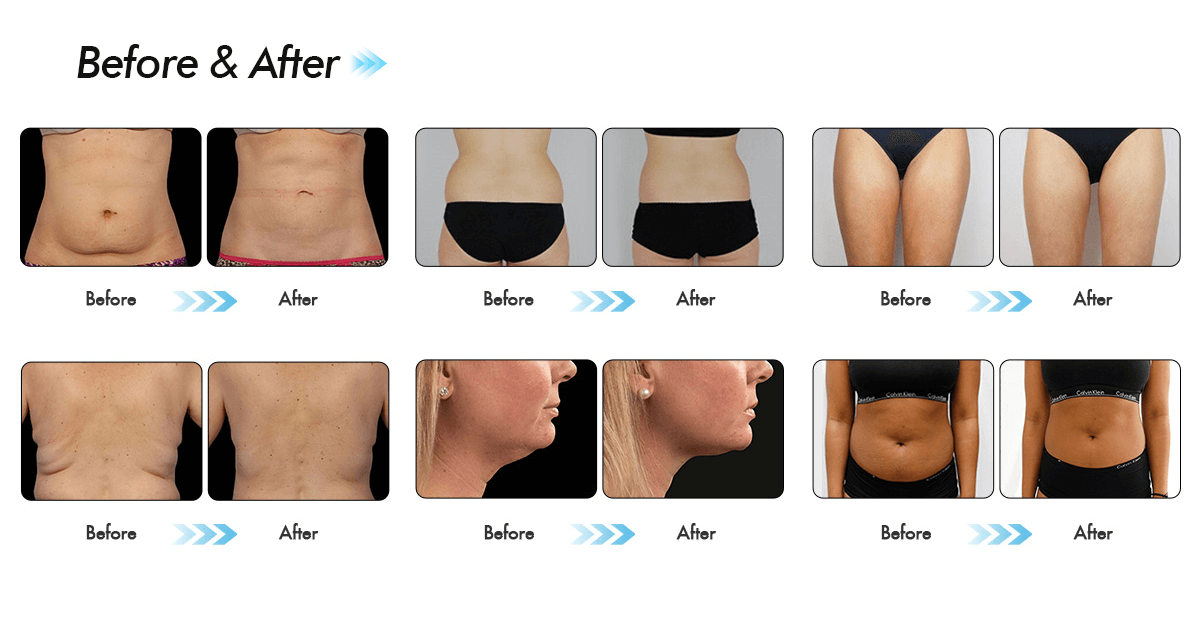 Máy Giảm Béo Quang Đông 360 CRYOLIPOLYSIS | Cao Cấp Bắc Kinh 12 MÁY GIẢM BÉO QUANG ĐÔNG 360 Cryolipolysis SANHE - 14