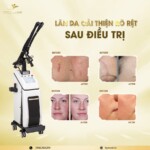 Sửa Chữa Máy Laser Co2 Fractional Tại Hồ Chí Minh Chuyên môn, Kinh nghiệm và Uy tín