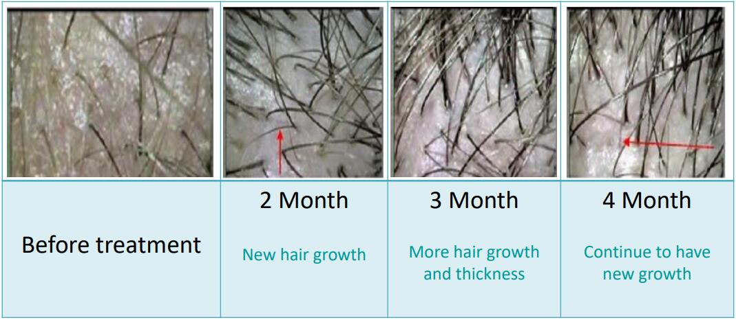 Hình ảnh so sánh da đầu trước và sau 2 3 4 tháng điều trị kích thích mọc tóc với mật độ tóc dày hơn