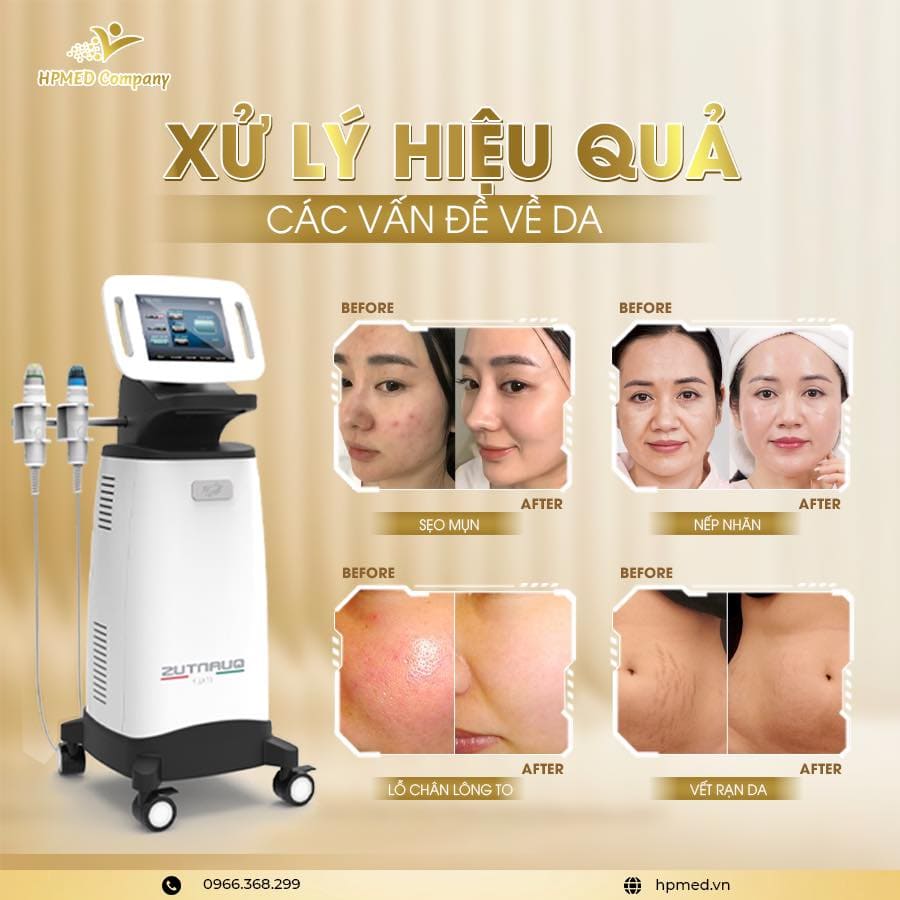 Máy RF Vi Điểm cùng hình ảnh trước sau trị sẹo mụn nếp nhăn lỗ chân lông to vết rạn da