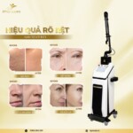 Máy Laser CO2 Fractional Pentagon Glass F Bóng Thủy Tinh Hàn Quốc ⭐ Ultra Pulse 20W – Chuẩn Điều Trị Sẹo &amp; Trẻ Hóa Da