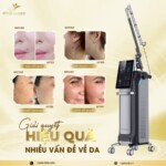 Máy Laser Co2 Fractional ZENIX GL068 – Đạt Chuẩn FDA Hoa Kỳ