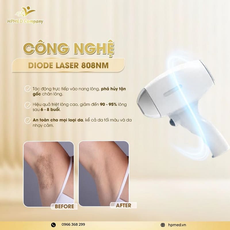 Máy triệt lông công nghệ diode laser 808nm HPMED kèm hình ảnh so sánh nách trước và sau khi điều trị