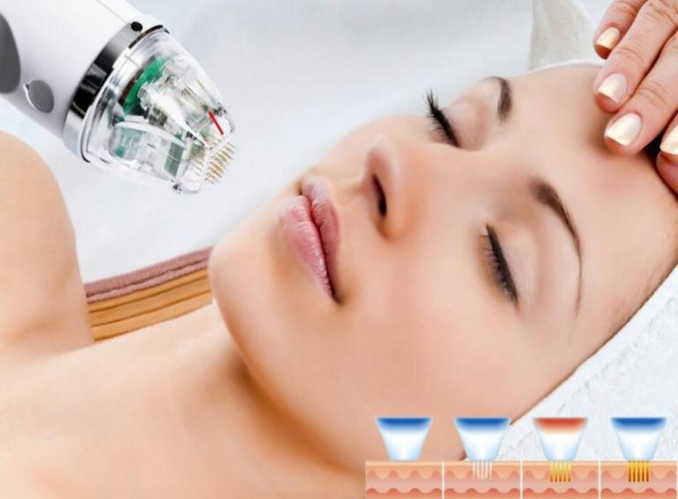 Sửa Máy RF Vi Điểm - Giải Pháp Nhanh Chóng và Hiệu Quả Số 1 Việt Nam 5 Sửa Máy RF Vi Điểm - Giải Pháp Nhanh Chóng và Hiệu Quả Số 1 Việt Nam